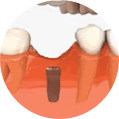 Dental Implant Step 1 Image