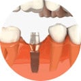 Dental Implant Step 2 Image