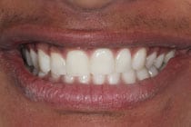Composite Dentistry Case 1 Composite Dentistry Case 1