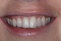 Composite Dentistry Case 3 Composite Dentistry Case 3