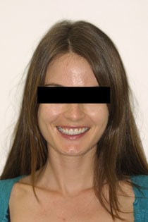 Porcelain Veneers Case 4 Porcelain Veneers Case 4
