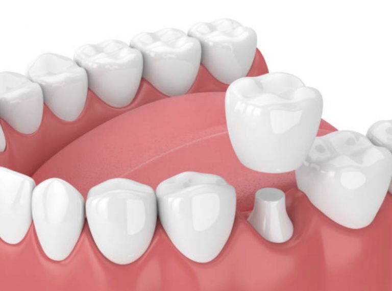 dental-crowns-treatment-costs-sydney-bondi-north-sydney