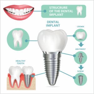 implant dentistry in sydney