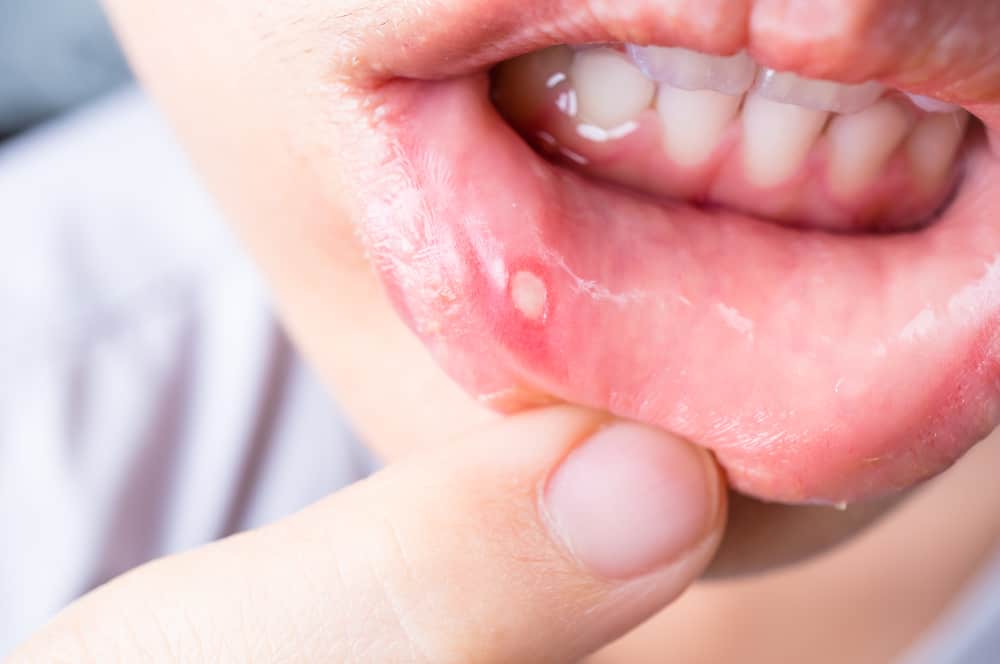 toothpaste to prevent canker sores